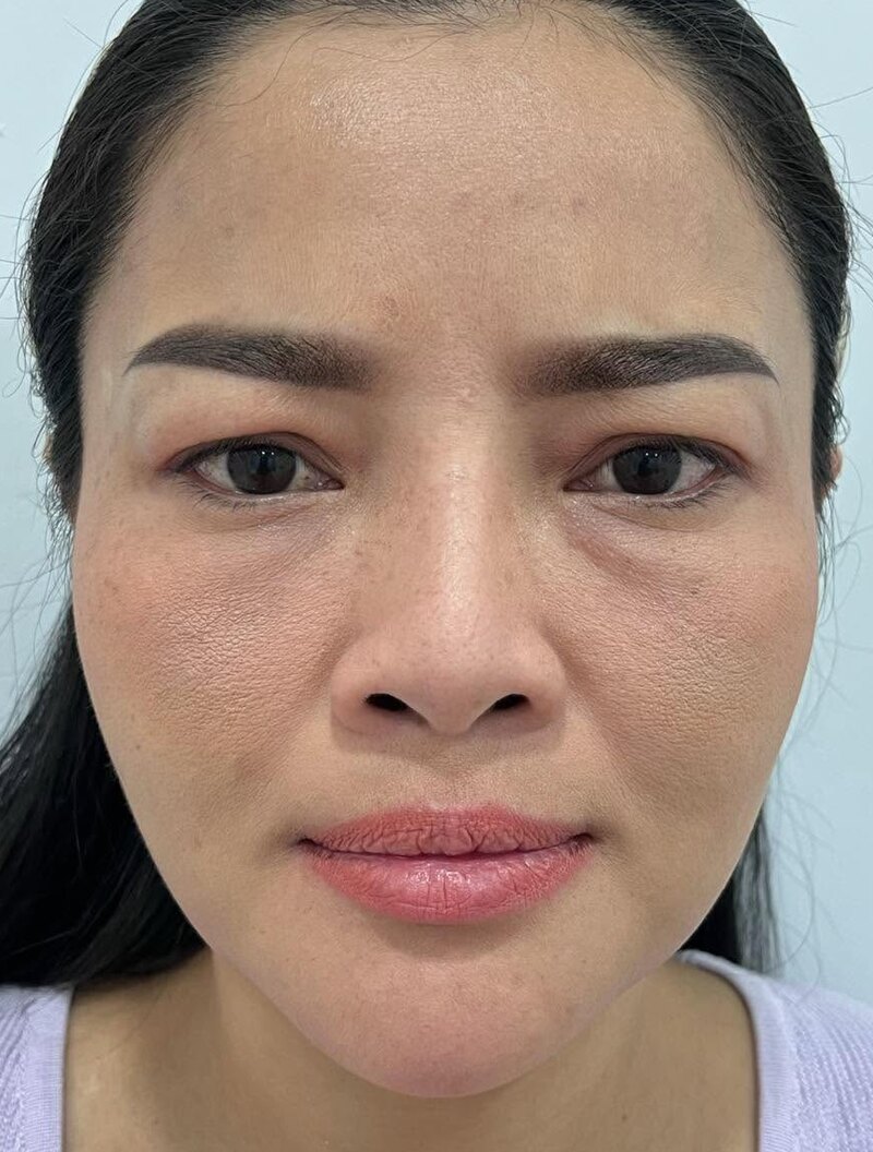 ใบหน้าหลังการดูแลด้วยโบท็อกซ์ (ตัวอย่างจากคลินิก)