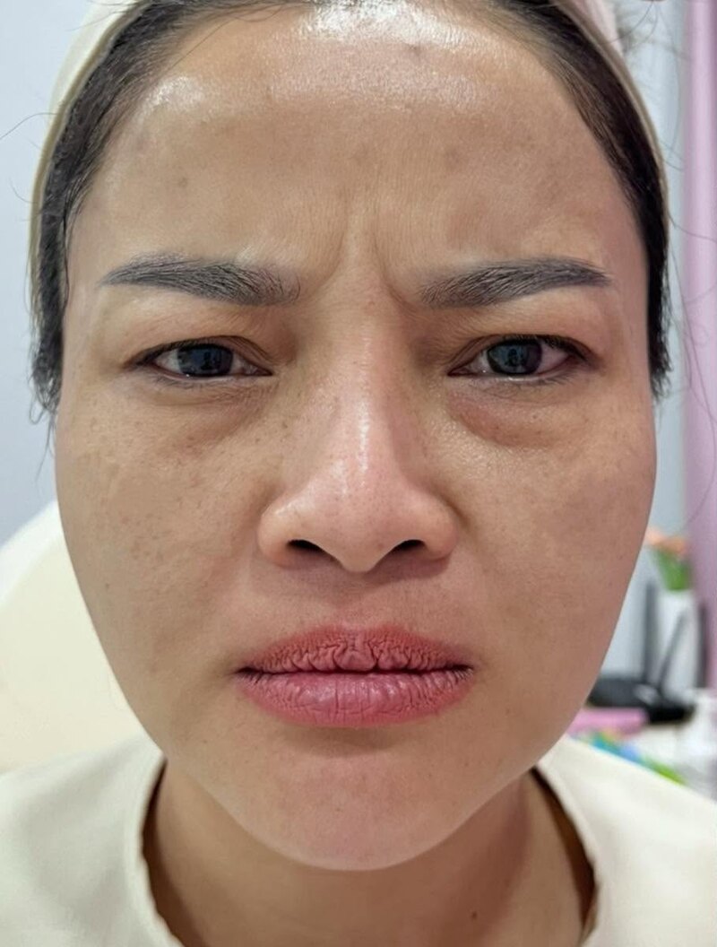 ใบหน้าก่อนการดูแลด้วยโบท็อกซ์ (ตัวอย่างจากคลินิก)