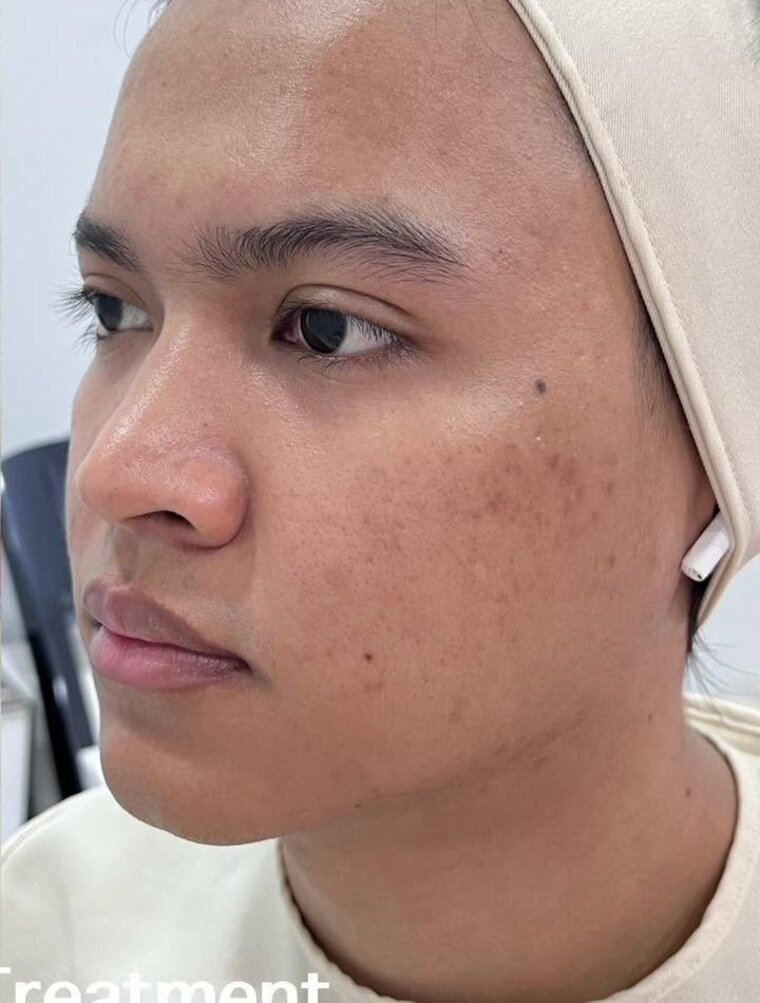ใบหน้าหลังการดูแลปัญหาสิว (ตัวอย่างจากคลินิก)