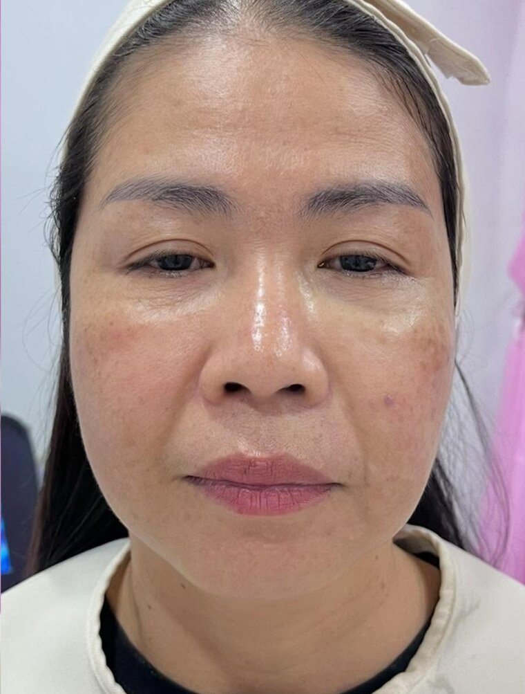 ใบหน้าหลังการดูแลผิวหน้า (ตัวอย่างจากคลินิก)