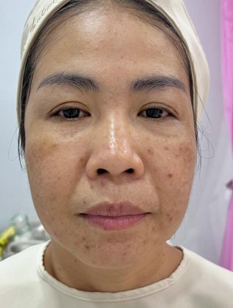 ใบหน้าก่อนการดูแลผิวหน้า (ตัวอย่างจากคลินิก)
