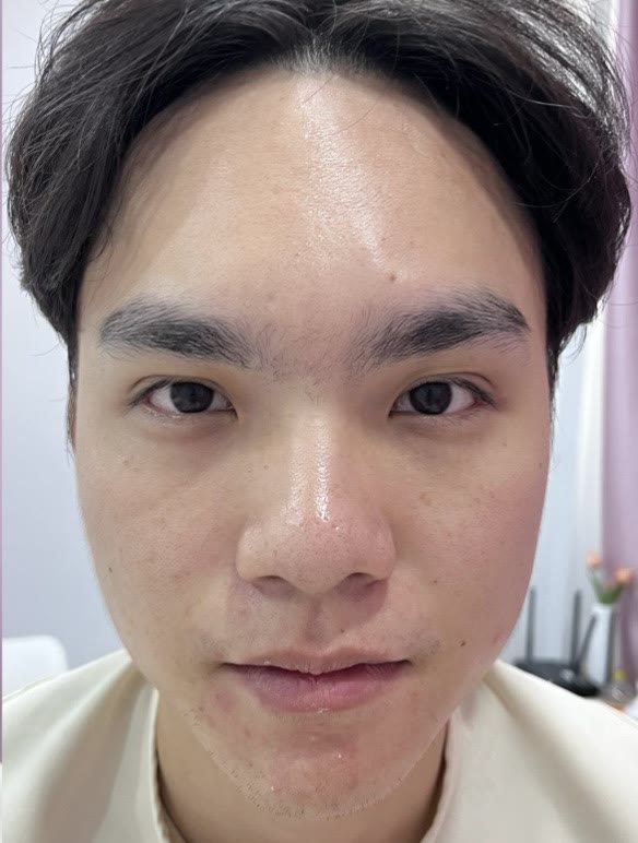 ใบหน้าหลังการดูแลด้วยโบท็อกซ์ (ตัวอย่างจากคลินิก)