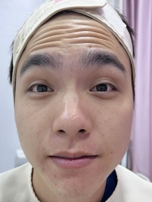 ใบหน้าก่อนการดูแลด้วยโบท็อกซ์ (ตัวอย่างจากคลินิก)