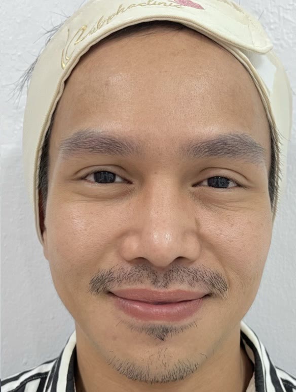 ใบหน้าหลังการดูแลด้วยโบท็อกซ์ (ตัวอย่างจากคลินิก)