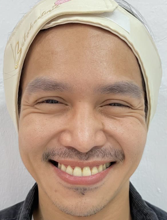 ใบหน้าก่อนการดูแลด้วยโบท็อกซ์ (ตัวอย่างจากคลินิก)