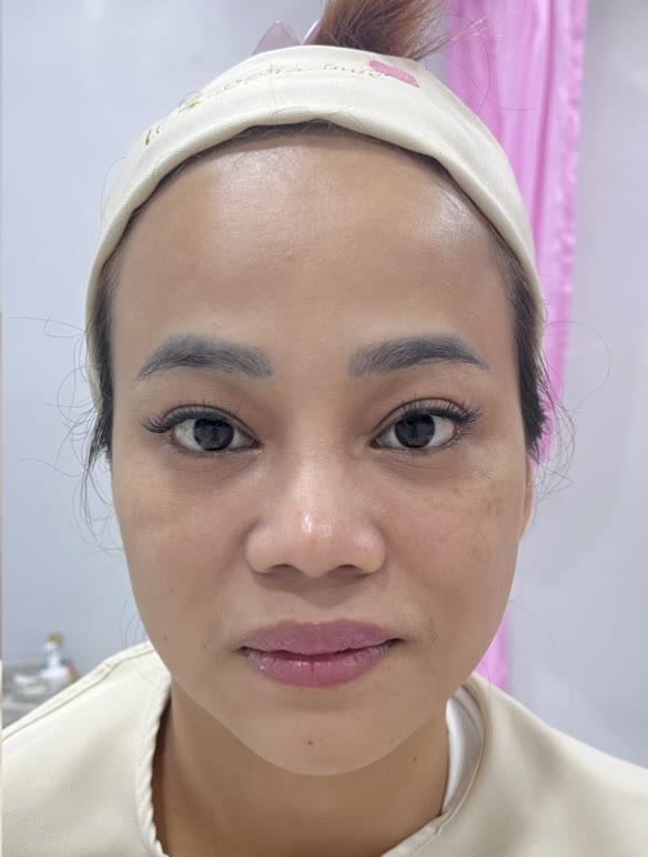 ใบหน้าหลังการดูแลผิวหน้า (ตัวอย่างจากคลินิก)