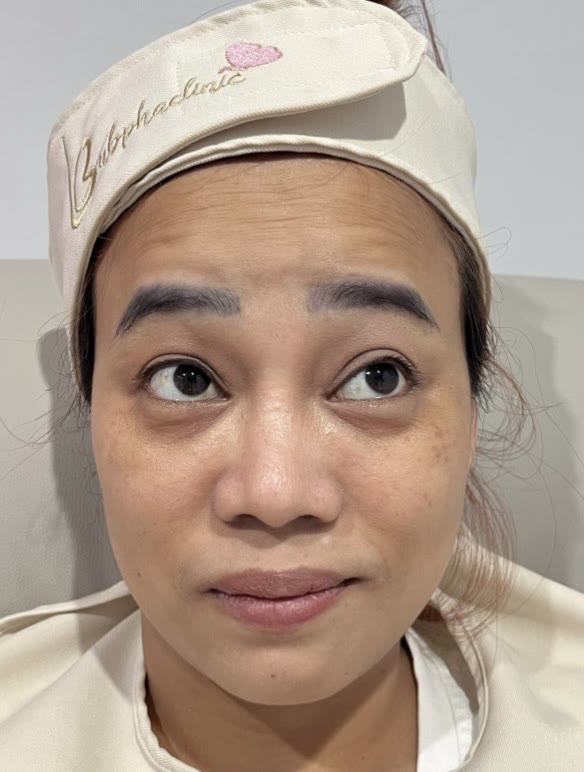 ใบหน้าก่อนการดูแลผิวหน้า (ตัวอย่างจากคลินิก)