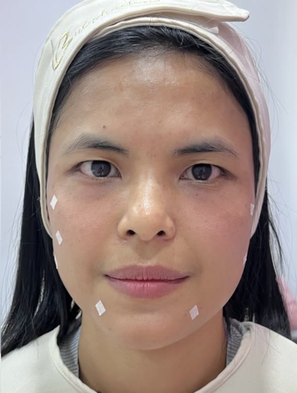 ใบหน้าหลังการดูแลผิวหน้า (ตัวอย่างจากคลินิก)