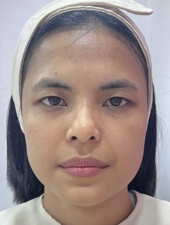 ใบหน้าก่อนการดูแลผิวหน้า (ตัวอย่างจากคลินิก)