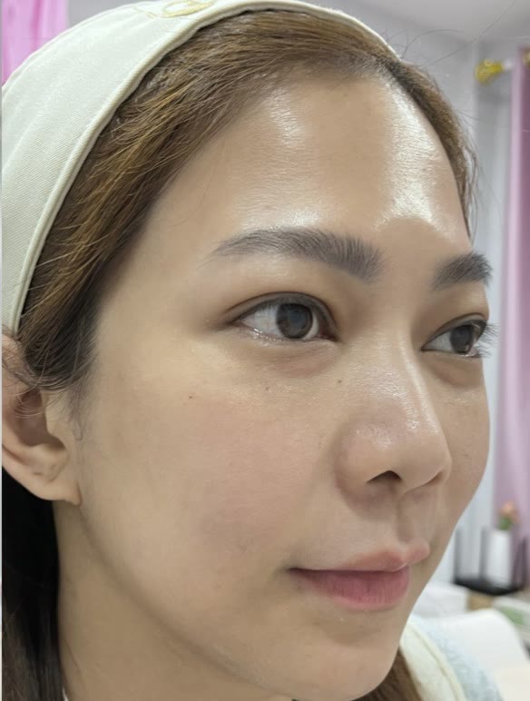 ใบหน้าหลังการดูแลผิวหน้า (ตัวอย่างจากคลินิก)